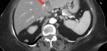 Portal Vein Thrombosis Associated With Fusobacterium nucleatum Bacteremia: A Rare Abdominal Variant of Lemierre's Syndrome - Cureus