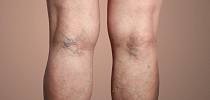 Varices des jambes : ces 4 symptômes qui doivent vous alerter - CNEWS