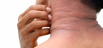 Prevent or Reduce Atopic Dermatitis Flare-Ups - Pharmacy Times