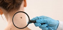 Don’t Ignore These Alarming Symptoms of Skin Cancer - News18
