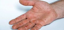 Dois novos casos de varíola dos macacos são confirmados em Blumenau - O Município Blumenau