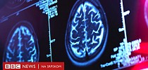 Медицина и наука: Нови лек против Алцхајмерове болести историјски помак, кажу научници - BBC