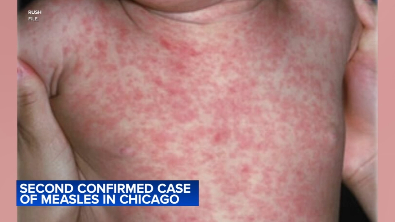 Measles in Chicago: Child diagnosed at Pilsen migrant shelter in second city case in 24 hours, CDPH says - WLS-TV